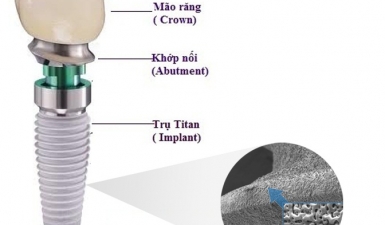 Những thành phần của implant bạn đã biết?